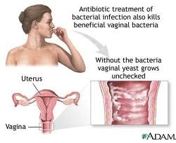 prevent yeast infection