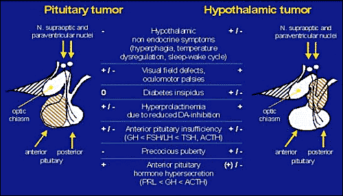 Schematic presentation of endocrine, visual, and neurological symptoms as they may occur in patients with pituitary (left) and suprasellar, hypothalamic lesions (right).