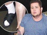 Too many workouts? Chaz Bono struggles to exit his car in a foot brace after revealing 60lb weight loss