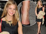 Erin Heatherton sported a gashed leg on Monday after the Met Ball in new York