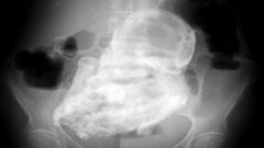PHOTO: A 40-year-old calcified fetus has been discovered inside the abdomen of an elderly woman in Bogotá, Colombia.