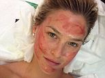 Suffering for beauty: The supermodel posted a photo on Instagram of her blood-spattered face