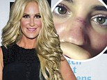 'Every mommy's worst fear': Kim Zolciak's daughter Brielle, 17, rushed to hospital with bloody nose after being hit in the face