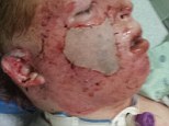 Dalton Henry, 15, was severely burned while helping his older cousin burn brush when a gas can exploded