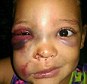 A campaign for 'justice' for a badly bruised toddler has gone viral - after the mother claimed she was attacked in a playground