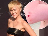 Well, that looks painful! Miley Cyrus reveals mystery arm injury in new naked snap