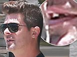 Picture Shows: Robin Thicke  July 14, 2015\n \n ** Min Web / Online fee £400 for set **\n \n R&B crooner Robin Thicke goes from smoothest to toothless as he reveals a missing tooth while leaving a dentist's office in Encino, California.\n \n The lady-loving 'Blurred Lines' singer must have been caught in the middle of dental surgery as he showed off the unsightly gaping hole where his front tooth used to be. Thicke was clearly not committed to oral hygiene as he puffed on a cigarette while waiting to fix his million dollar smile.\n \n ** Min Web / Online fee £400 for set **\n \n EXCLUSIVE ALL Rounder\n UK RIGHTS ONLY\n FameFlynet UK © 2015\n Tel : +44 (0)20 3551 5049\n Email : info@fameflynet.uk.com