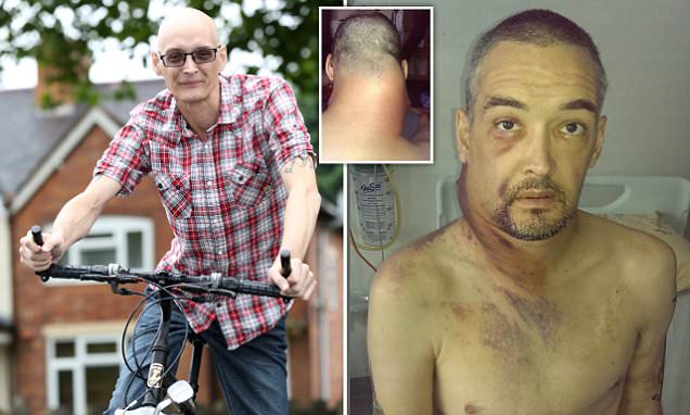 Bike crash saved father's life after a tumour the size of MELON grew days later