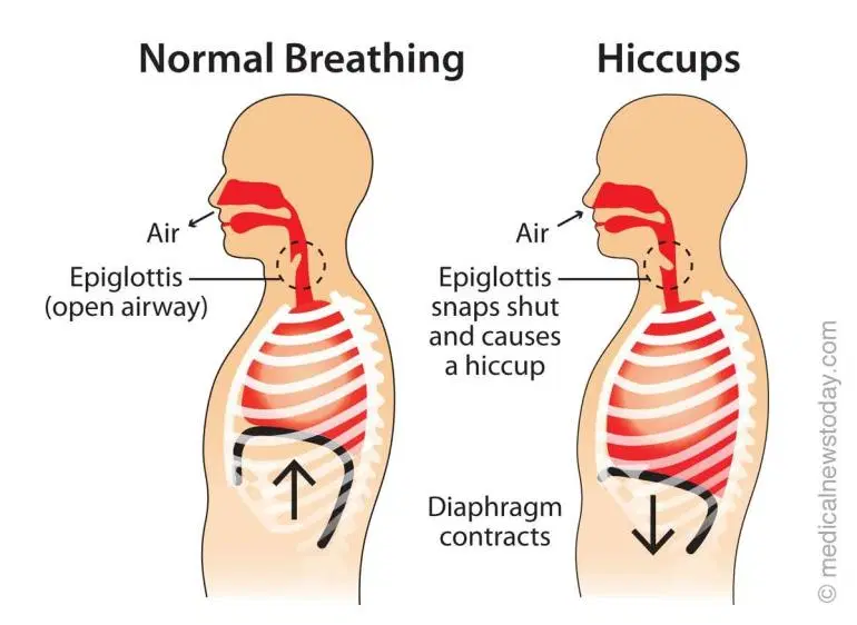 Diagram of how hiccups occur