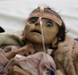 In this Tuesday, March 22, 2016 photo, infant Udai Faisal, who is suffering from acute malnutrition, is hospitalized at Al-Sabeen Hospital in Sanaa, Yemen. Udai died on March 24. Hunger has been the most horrific consequence of Yemen¿s conflict and has spiraled since Saudi Arabia and its allies, backed by the U.S., launched a campaign of airstrikes and a naval blockade a year ago. (AP Photo/Maad al-Zikry)