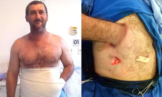 Surgeons save man's hand by sewing it into a pocket made from his own belly 