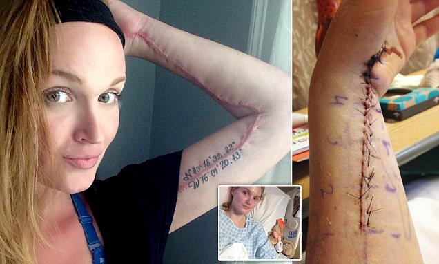 Syracuse woman left fighting for life after bruise turned out to be flesh eating bug