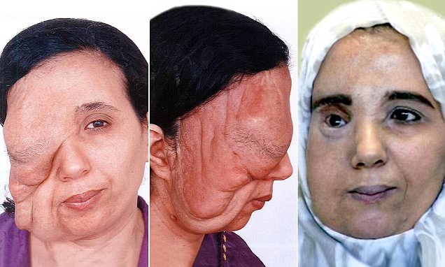 Morocco mother disowned by husband after facial tumours ravaged her looks