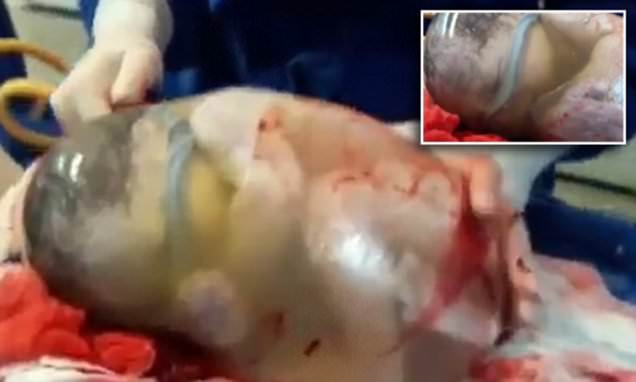 Spanish baby is born while still inside the amniotic sac captured on video