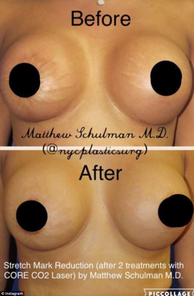 'Improvement': This picture demonstrates a woman who had two of four treatments on her stretch marks