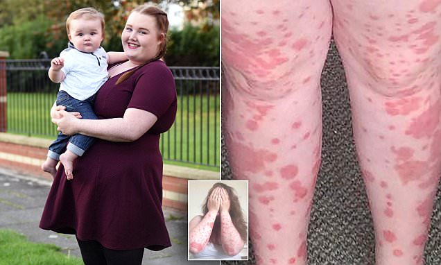 Teenage mother says being pregnant triggered psoriasis skin condition