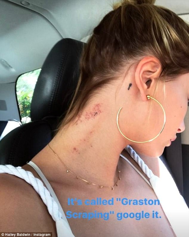 Ouch: The 20-year-old covergirl was also sporting a large, painful-looking scratch on the back of her neck, which she addressed on Instagram'