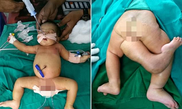Doctors remove extra limb from Indian girl with three legs
