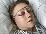 Katie Addison-Snart, 36, was on her way to drop her son off at nursery when she was struck in the forehead by the razor-sharp steel square. Pictured in hospital following surgery