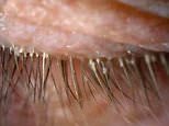 The woman, only known as Ms Xu, told doctors that she had suffered itchy, red eyes for two years, and they eventually found 100 mites living in her eyelashes