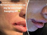 Johnny Manziel's fiancee Bre Tiesi shared a photo of a nasty face wound with the caption 'legit hanging off' after she broke up a fight between her two pet dogs and another dog on Saturday