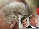 According to a new book, first daughter Ivanka Trump (left) has gabbed to friends about her father's unusual hairdo, explaining it's the product of a scalp reduction surgery and a combover 