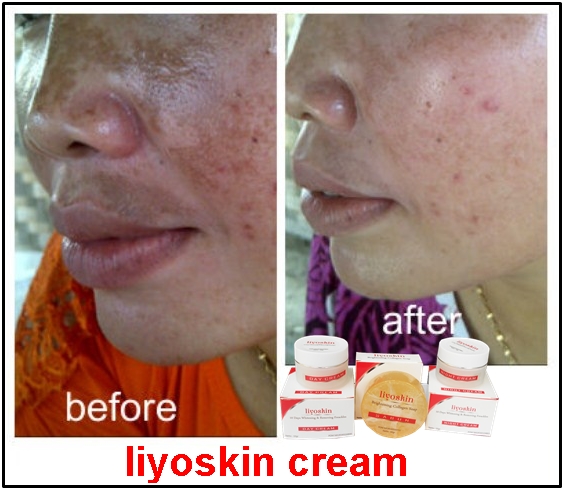 Liyoski Cream Wajah Ampuh Atasi Flek Hitam 