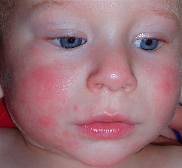 Аллергический диатез у детей фото