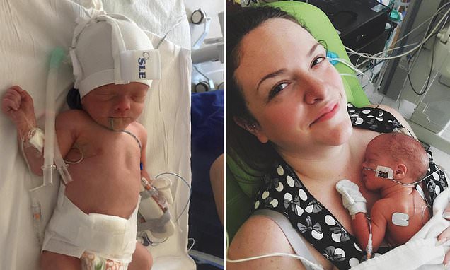 Doctors use keyhole surgery to repair spine of spina bifida baby in UK first