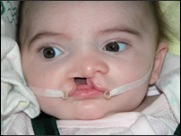 Child with a cleft lip