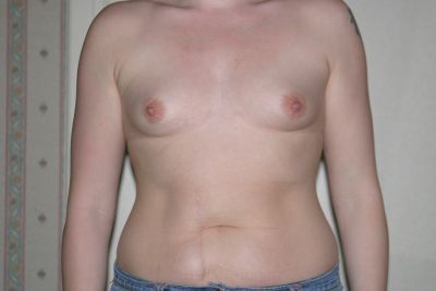 sarah flowers breast enlargement surgery before picture 1