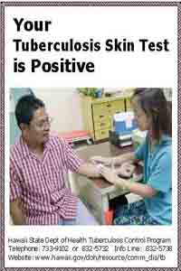 Your TB skin test is positive