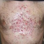 Chest Acne image