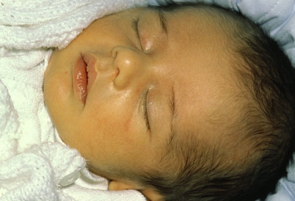 чрезмерное количество билирубина у новорожденного