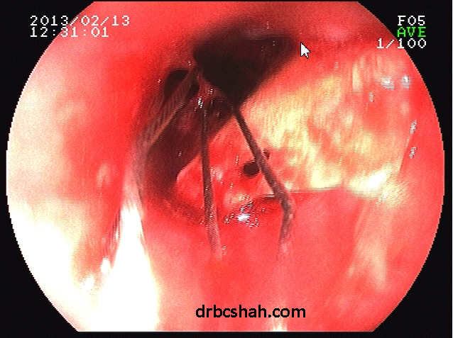 Endoscopic removal of fish bone from esophagus by Dr. B C Shah at Bhaktivedanta Hospita 