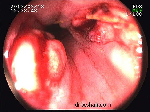 Ulcerations in esophagus at the site of impaction of fish bone seen on opposite walls