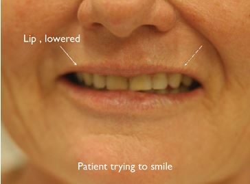lips Case Study: Revitalising the face with a dentofacial makeover 