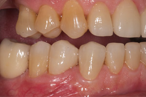 image 8 Case Study: Restoring the Smile with a Full Mouth Rehabilitation 