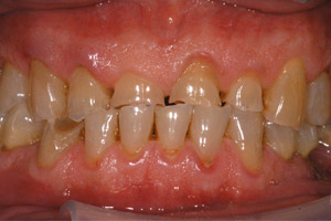 image 9 Case Study: Restoring the Smile with a Full Mouth Rehabilitation 