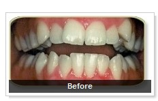 Before Straight Teeth in 6 Months accelerated ortho