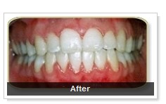After Straight Teeth in 6 Months fast orthodontics