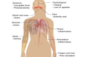juvenile-systemic-lupus-erythematosus-symptoms