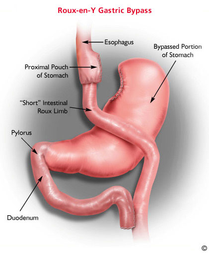 Gastric bypass sugery
