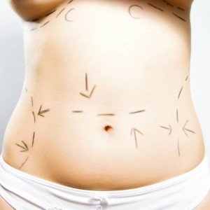 Berlin Township NJ liposuction