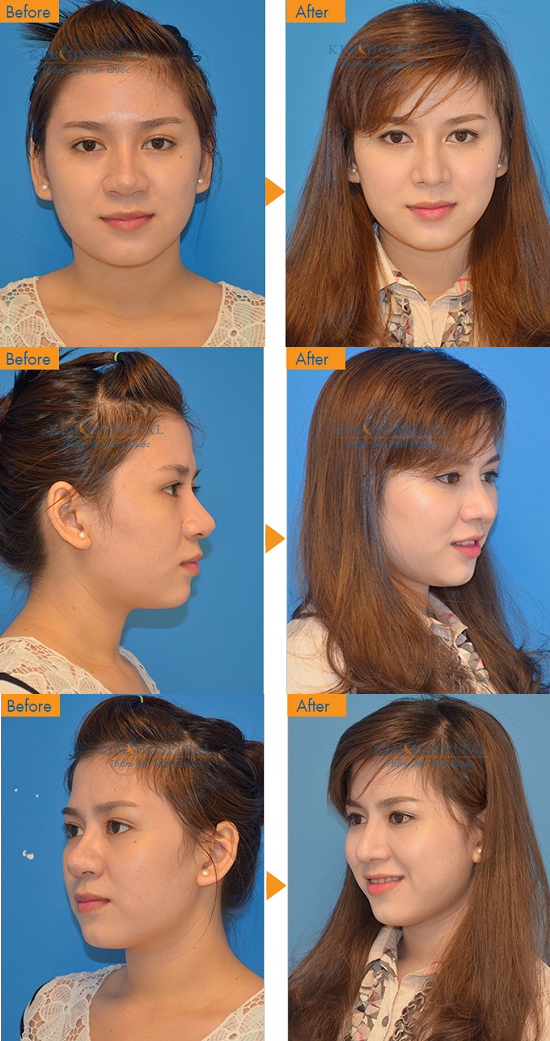 Sau nâng mũi s line, sống mũi được nâng cao tạo khuôn mặt nữ tính