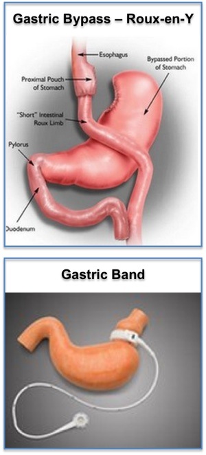 Gastric Bypass Surgery vs Gastric Lap Band Surgery