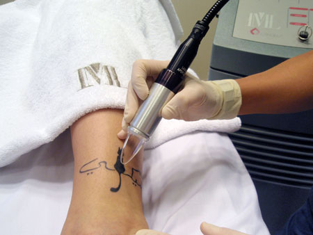 Láser Q-Switched, el mejor tratamiento para eliminar un tatuaje