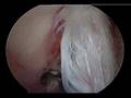Description: Bicep tendon repair