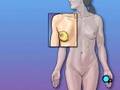 Description: PreOp® Patient Education : Mastectomy Radical Surgery