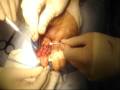 Description: flexor tendon repair zone 1 